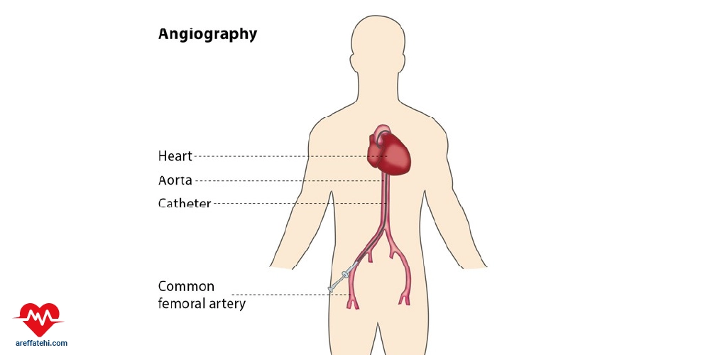آنژیوگرافی اورژانسی