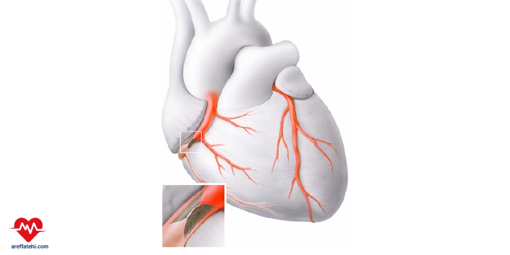 آنژیوگرافی قلب