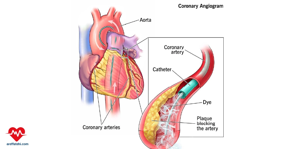 آنژیوگرافی قلب