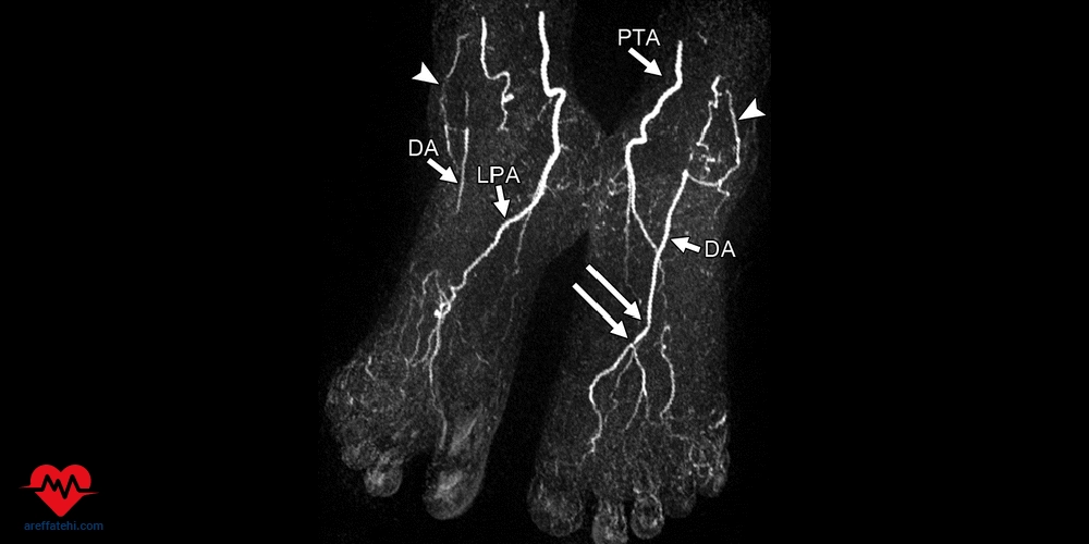 آنژیوگرافی پای دیابتی