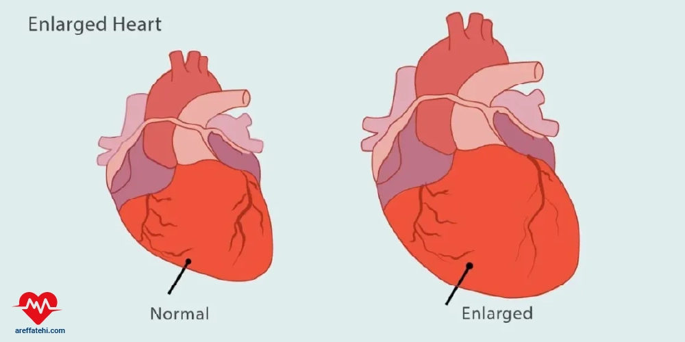 بزرگ شدن قلب