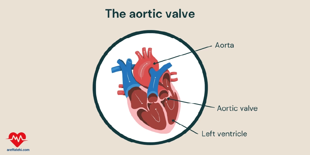 تنگی دریچه آئورت چیست