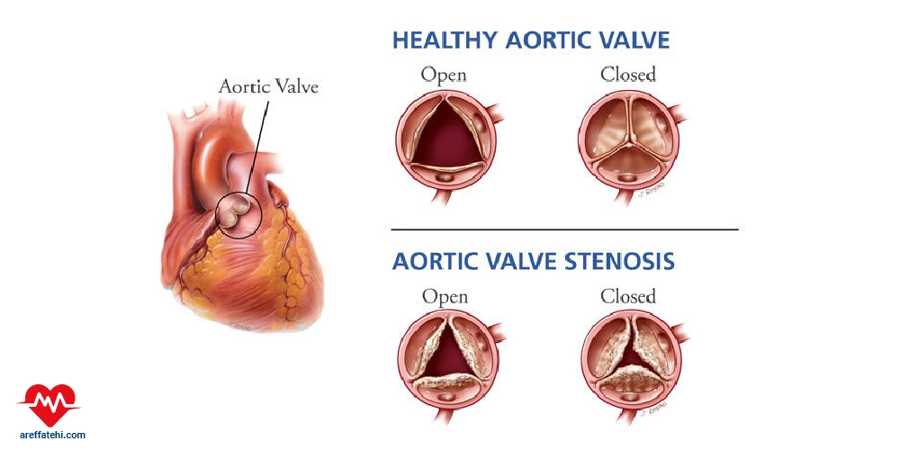 تنگی دریچه آئورت چیست