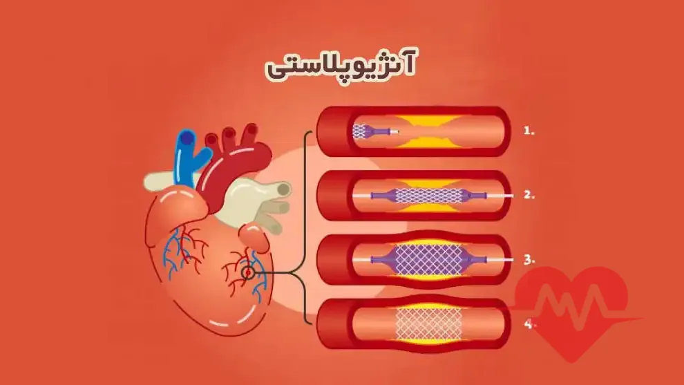 آنژیوپلاستی چگونه انجام می‌شود