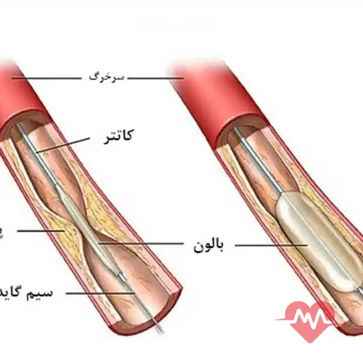 آنژیوپلاستی
