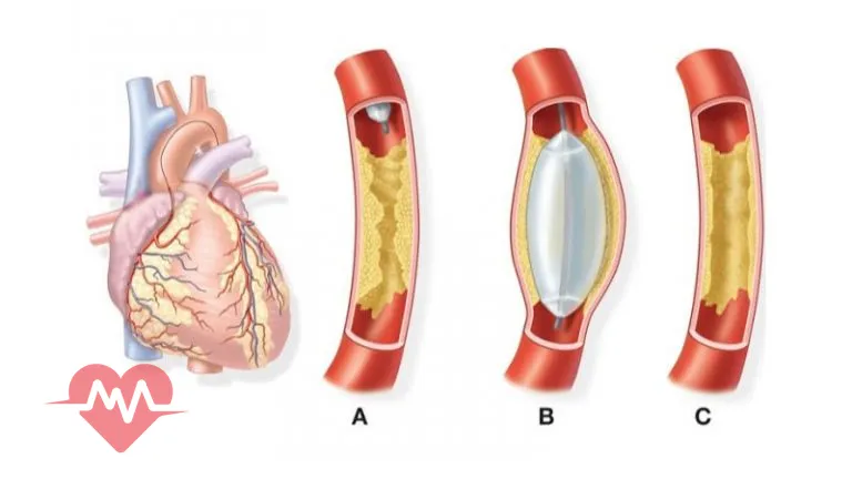 آنژیوگرافی