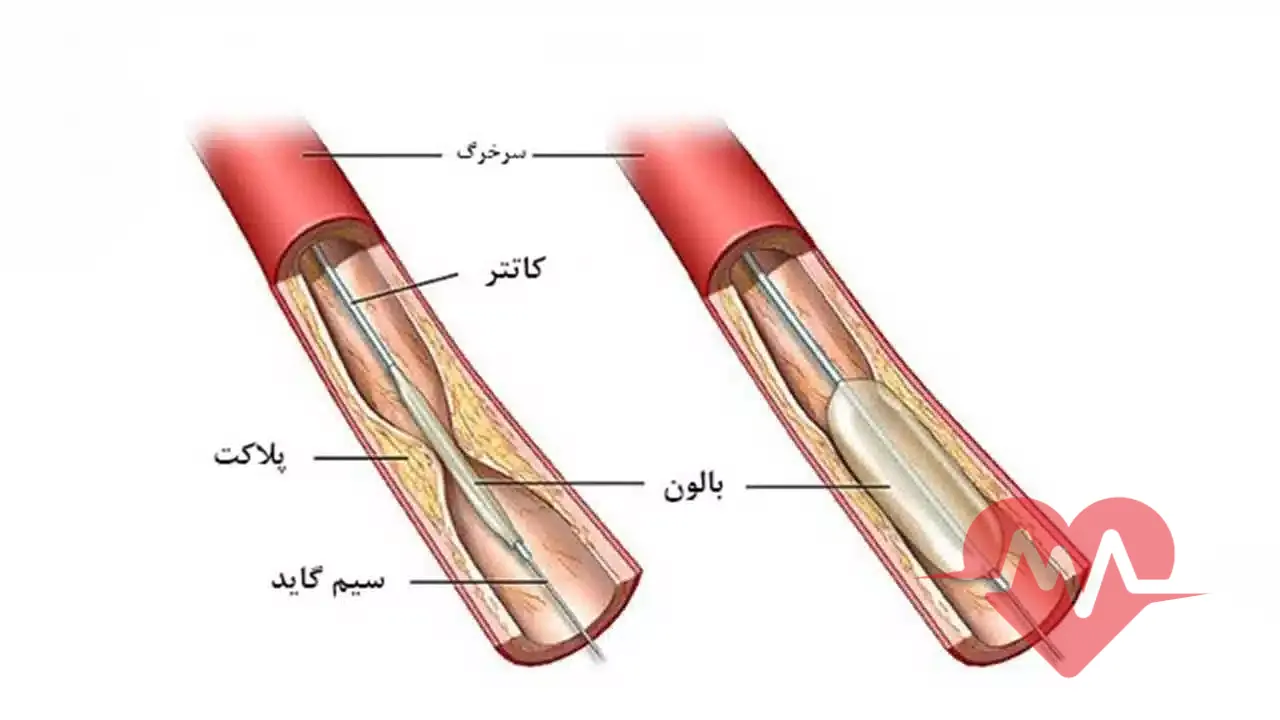 انواع آنژیوپلاستی