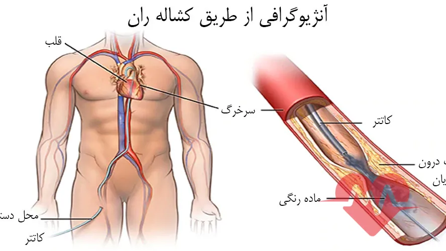 انواع آنژیوگرافی