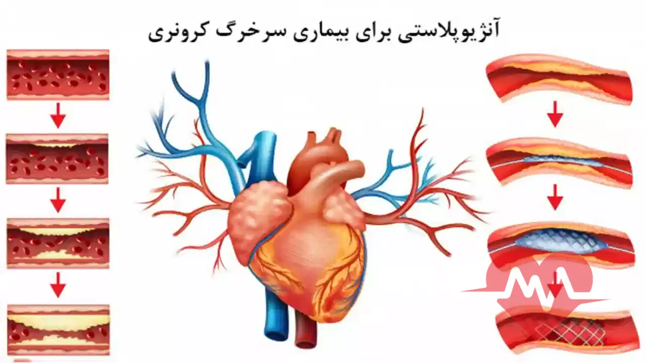 خطرات آنژیوپلاستی