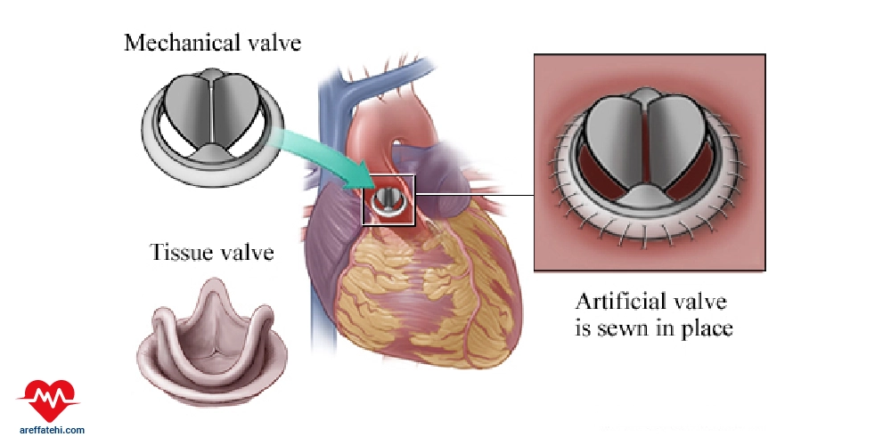 تعویض دریچه