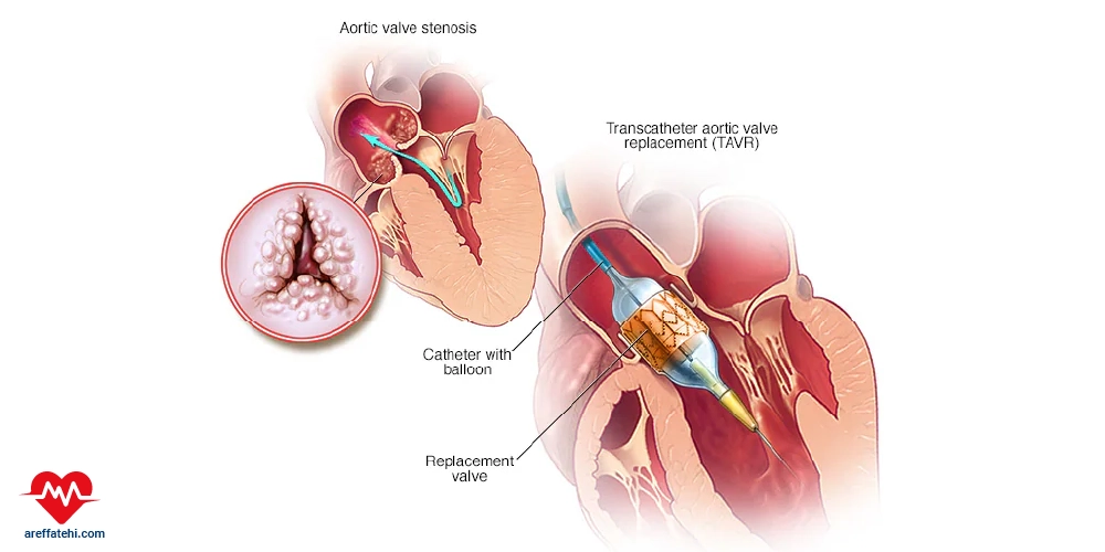 تعویض دریچه