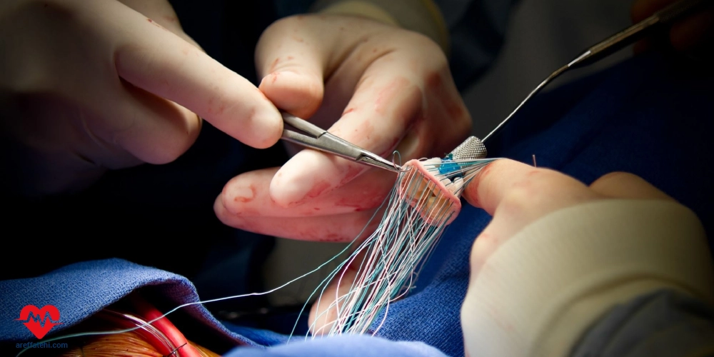 تعویض دریچه