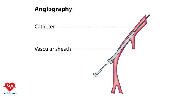 آنژیوگرافی تهران