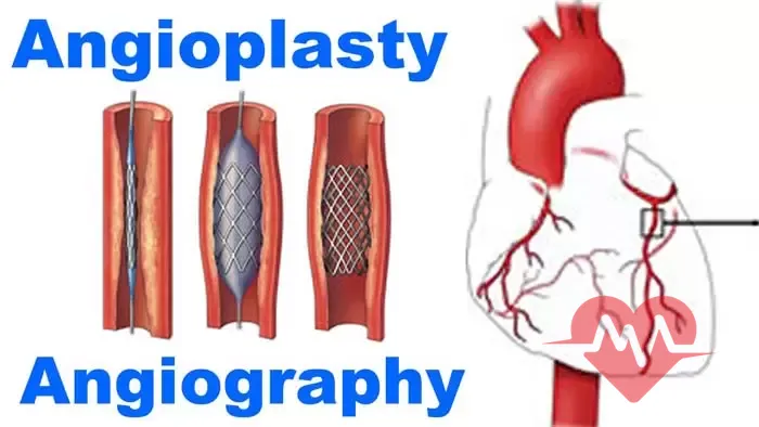 تفاوت‌ های کلیدی بین آنژیوگرافی و آنژیوپلاستی