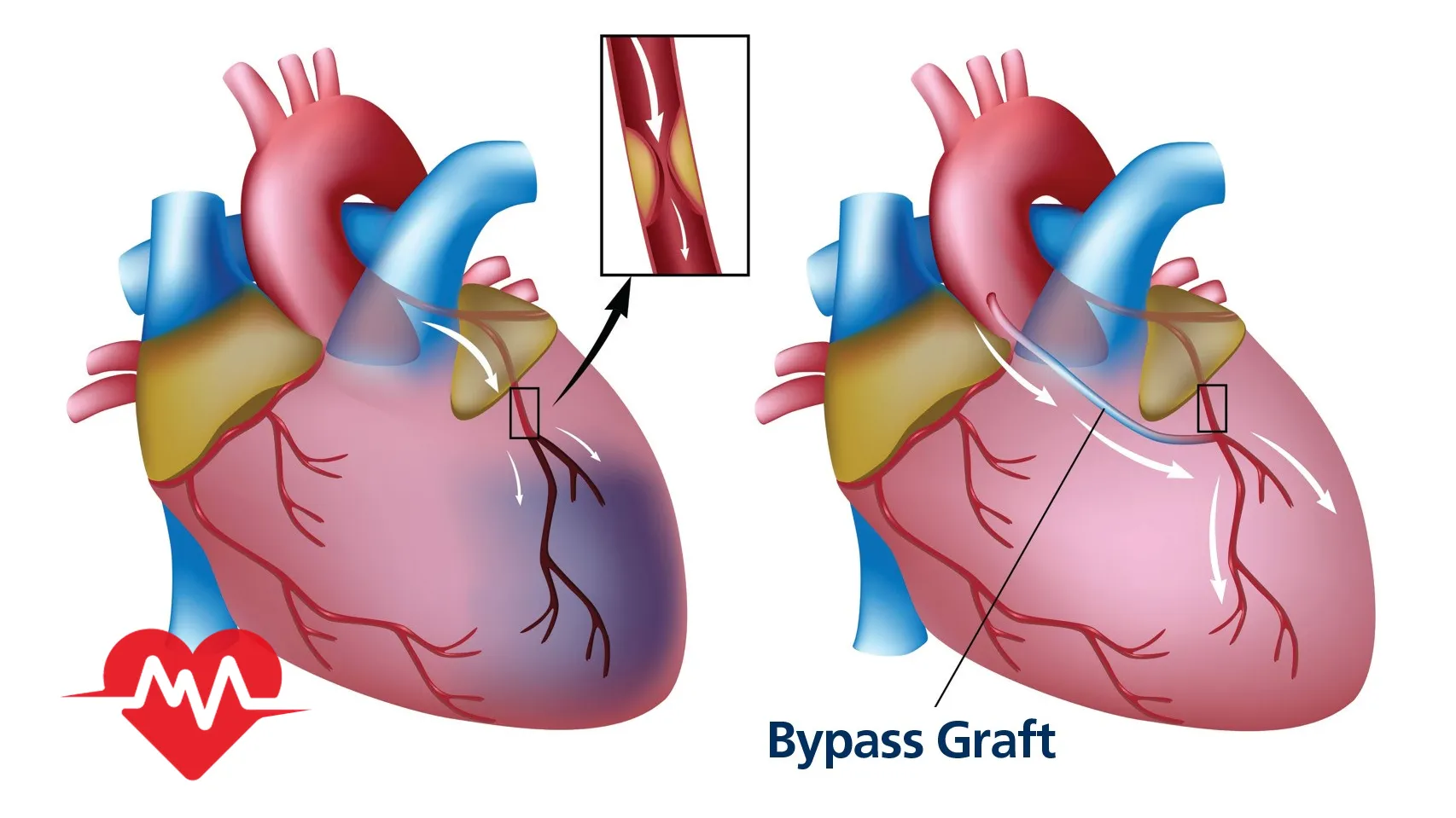 cabg چیست