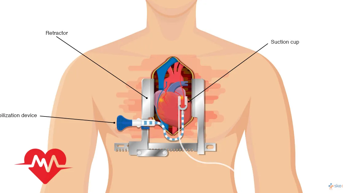 cabg چیست