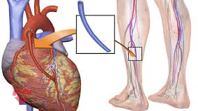 عمل بای پس عروق پا