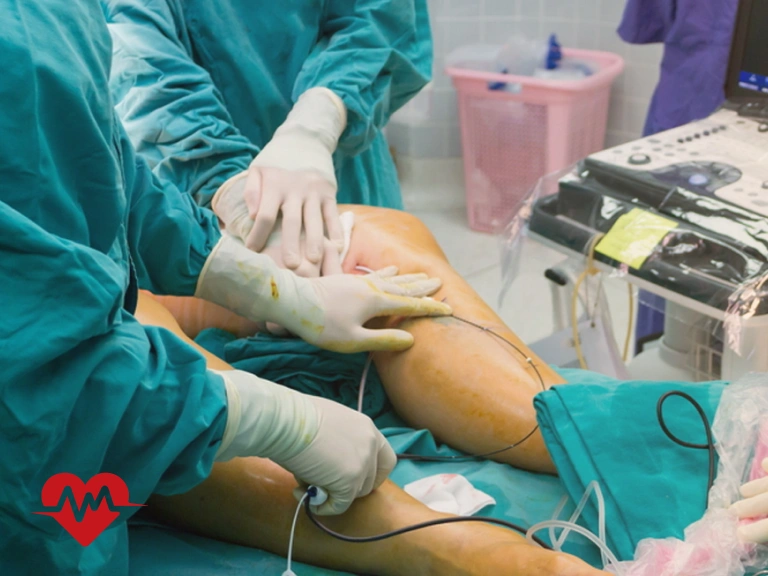 درد پا بعد از آنژیوگرافی