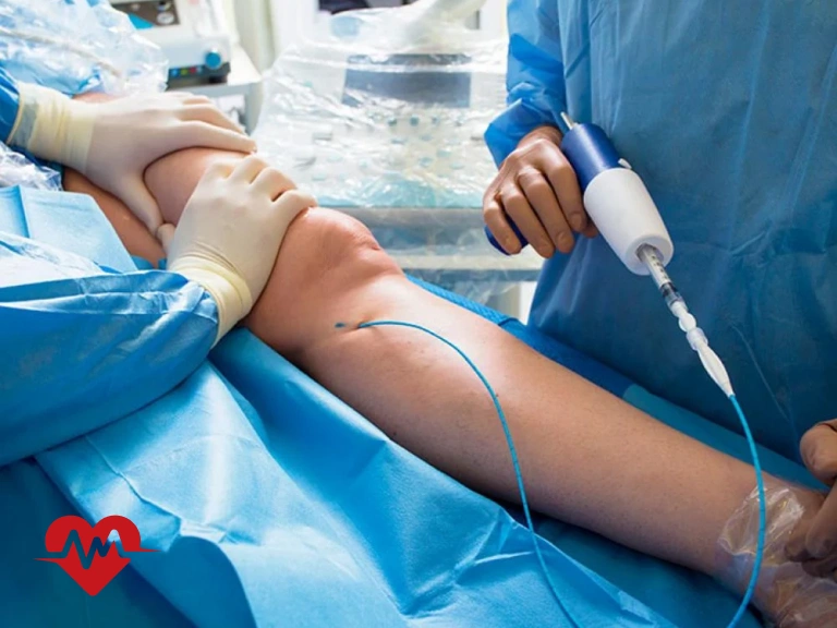 درد پا بعد از آنژیوگرافی