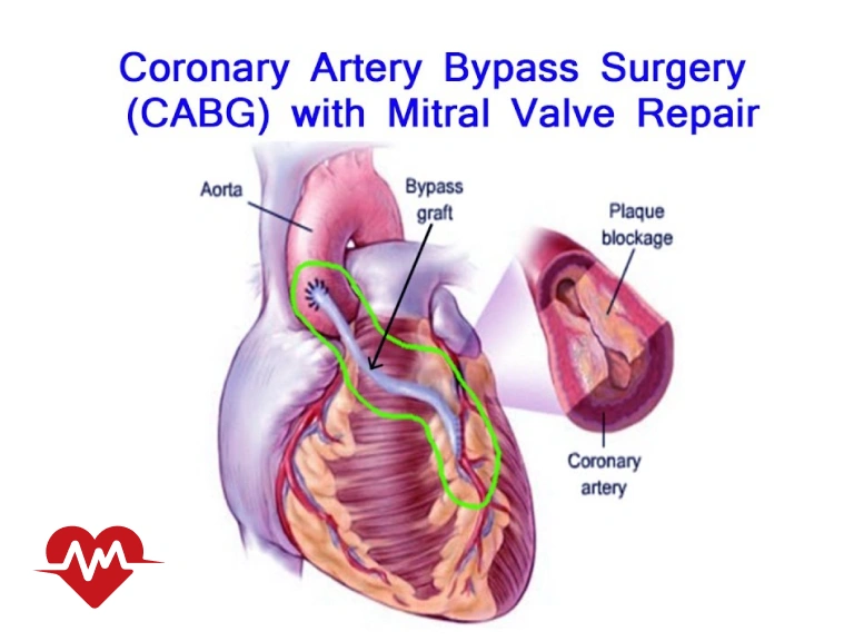 عوارض عمل بای پس قلب