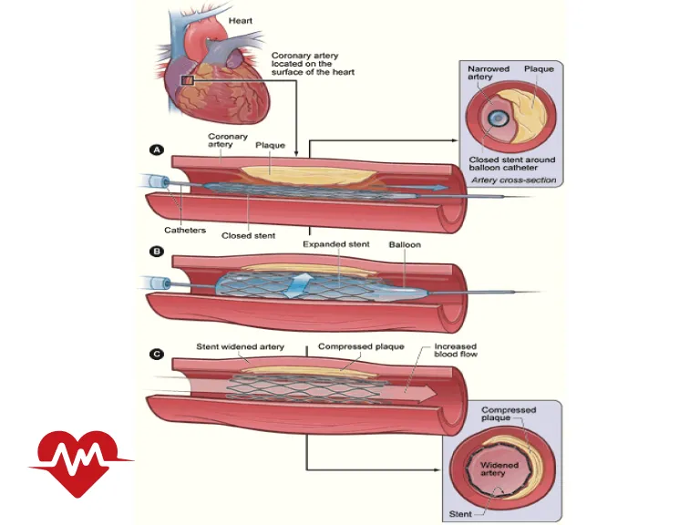 استنت دارویی