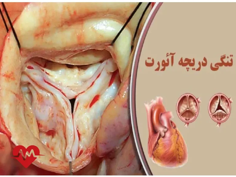 تنگی دریچه آئورت