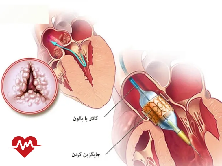 تنگی دریچه آئورت