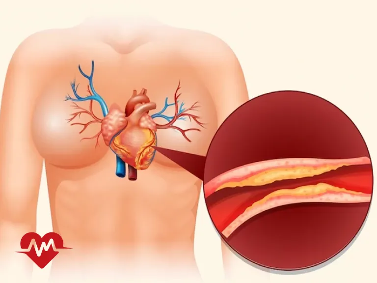 فرق انژیو و بالن قلب
