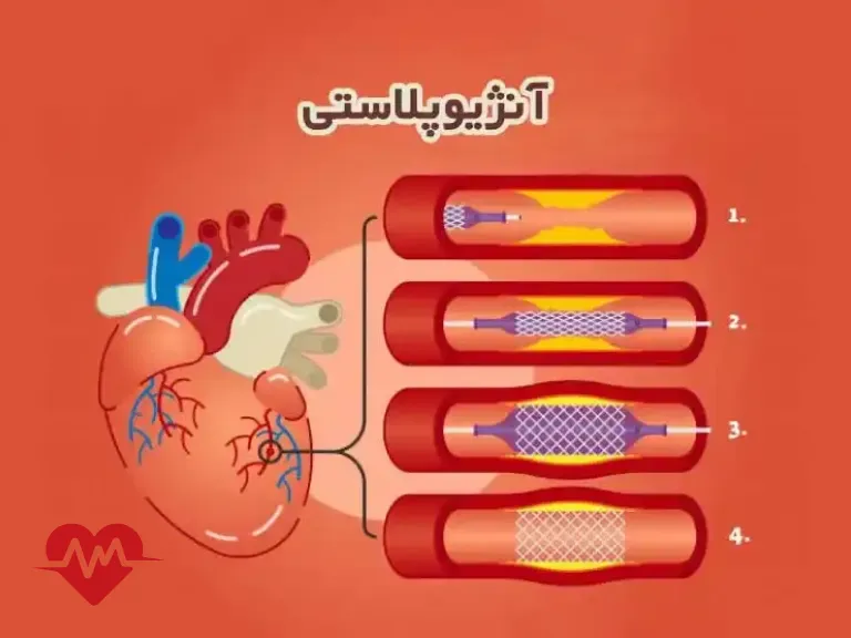 فرق انژیو و بالن قلب
