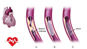 نحوه آنژیوپلاستی