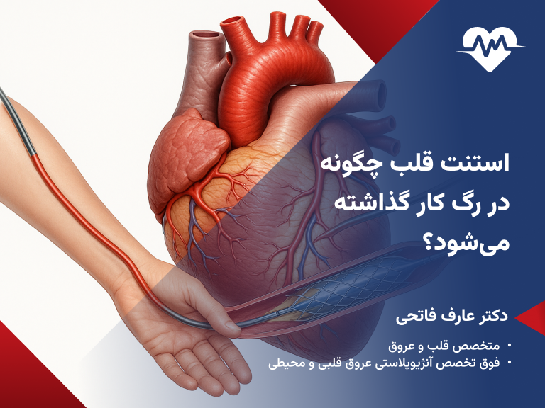 نحوه استنت گذاری قلب