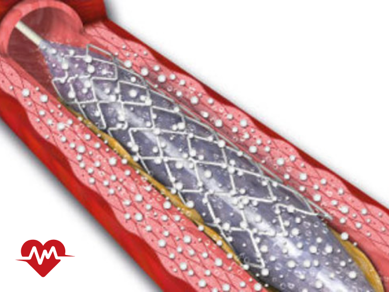 انواع استنت