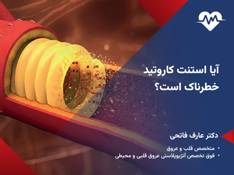 استنت کاروتید