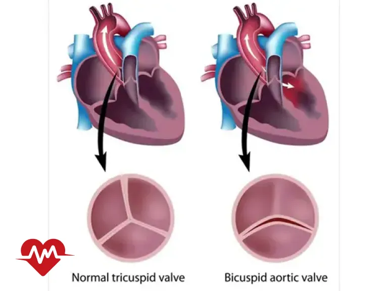 دریچه آئورت دو لتی