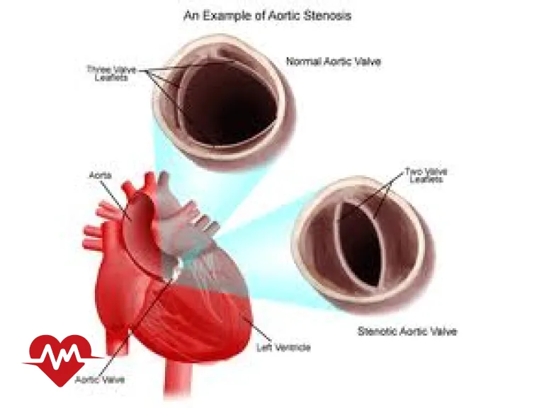 دریچه آئورت دو لتی