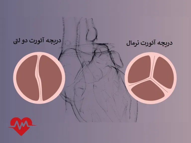 دریچه آئورت دو لتی