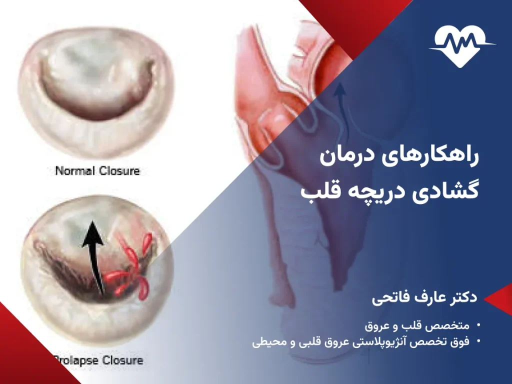 برای گشادی دریچه قلب چه باید کرد