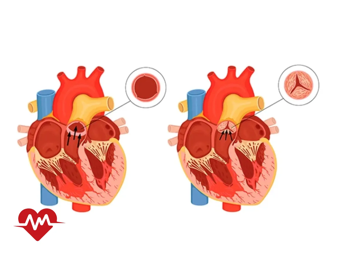 ایا تنگی دریچه میترال خطرناک است