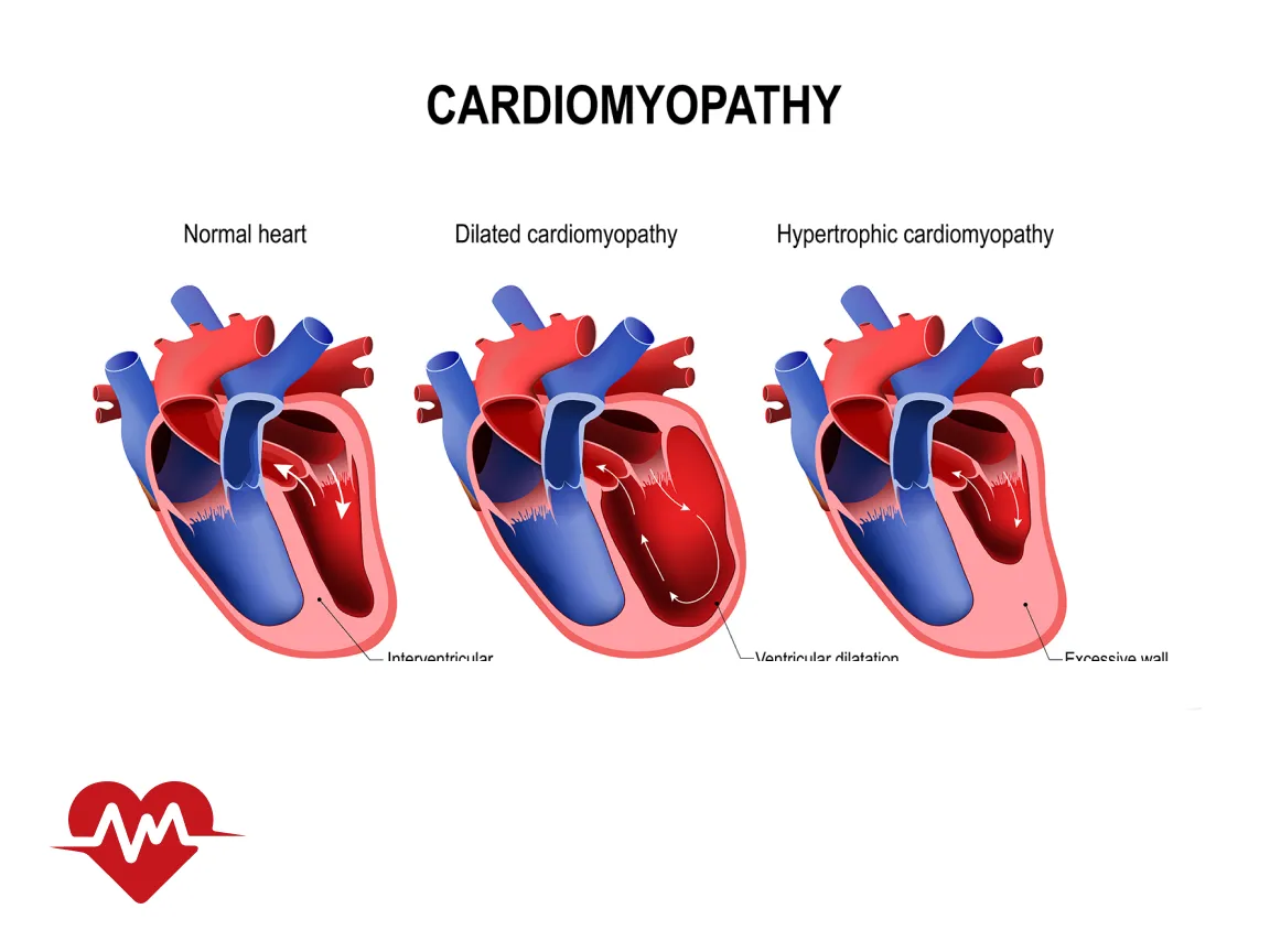 درمان گشادی دریچه قلب