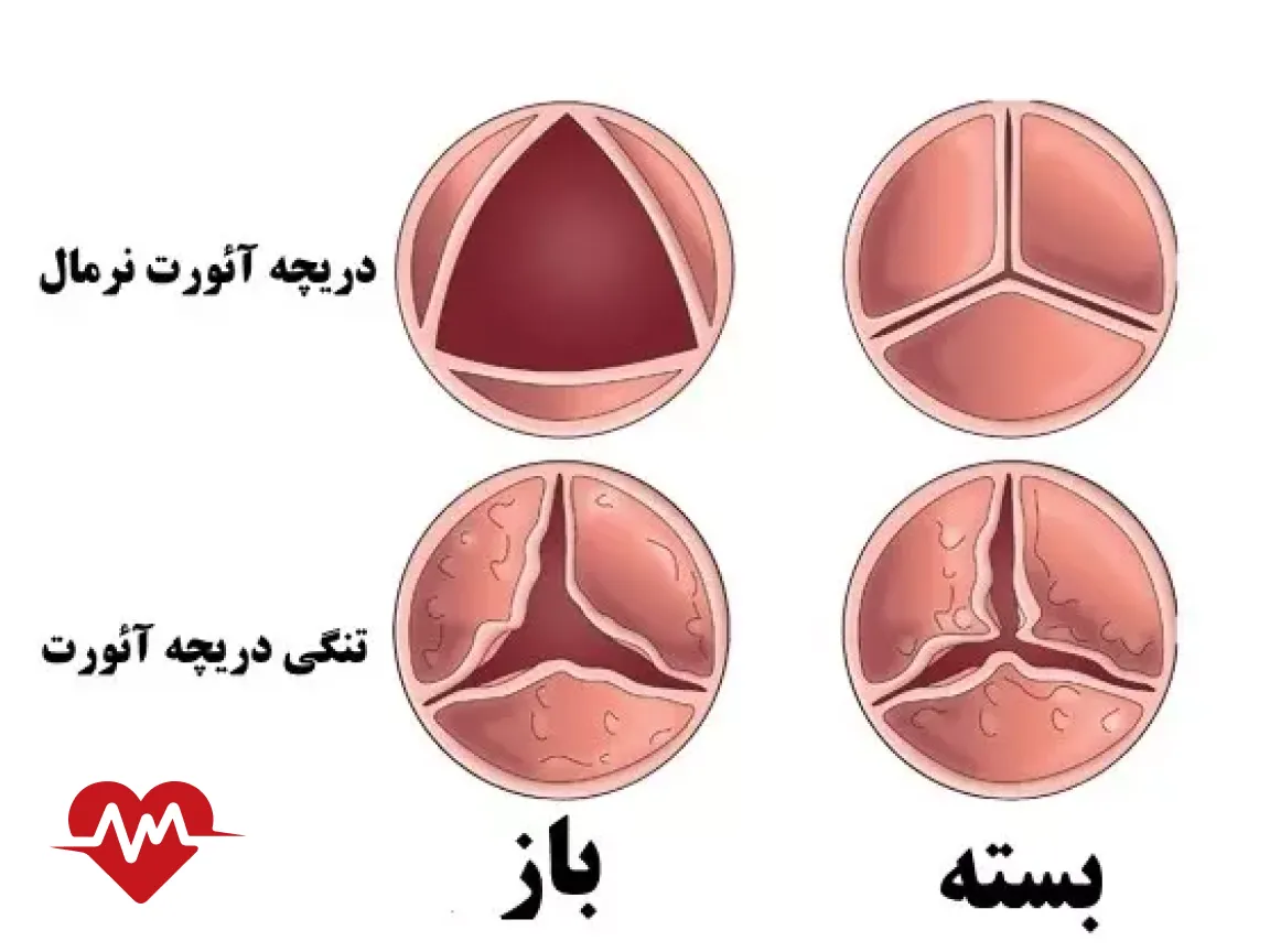 درمان تنگی دریچه آئورت بدون جراحی