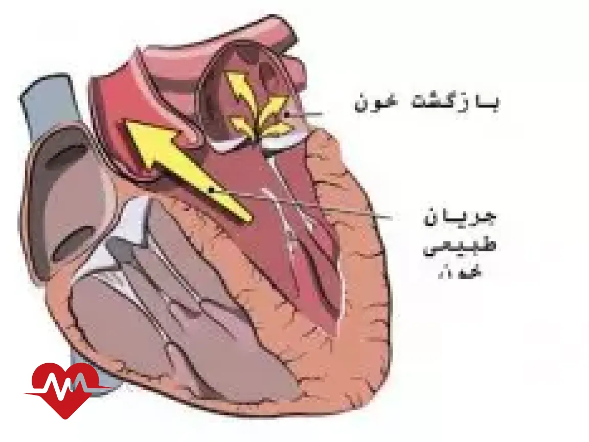 ایا نارسایی دریچه میترال درمان دارد