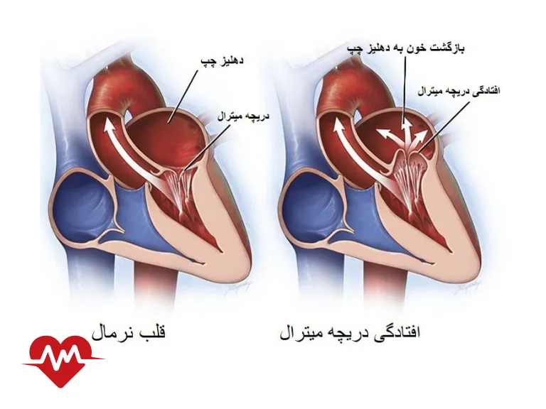 نرمی دریچه میترال قلب
