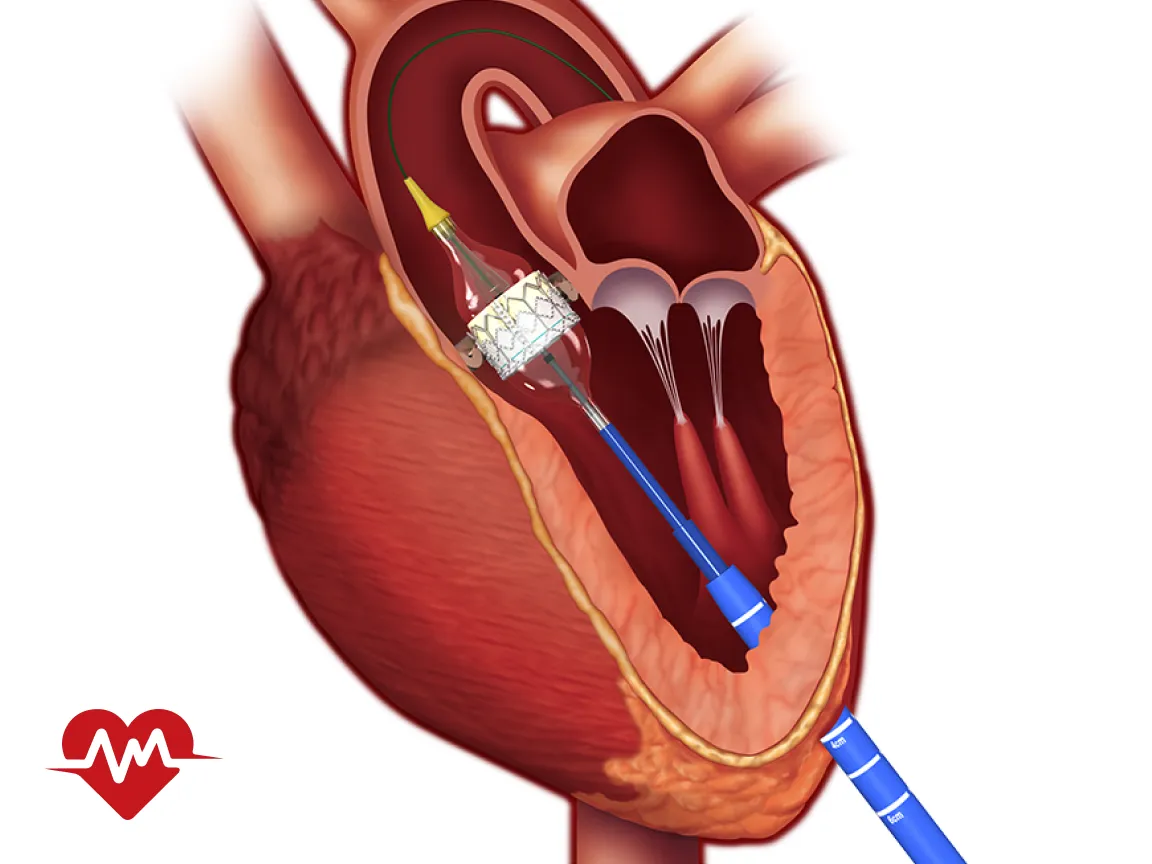 برای گشادی دریچه قلب چه باید کرد