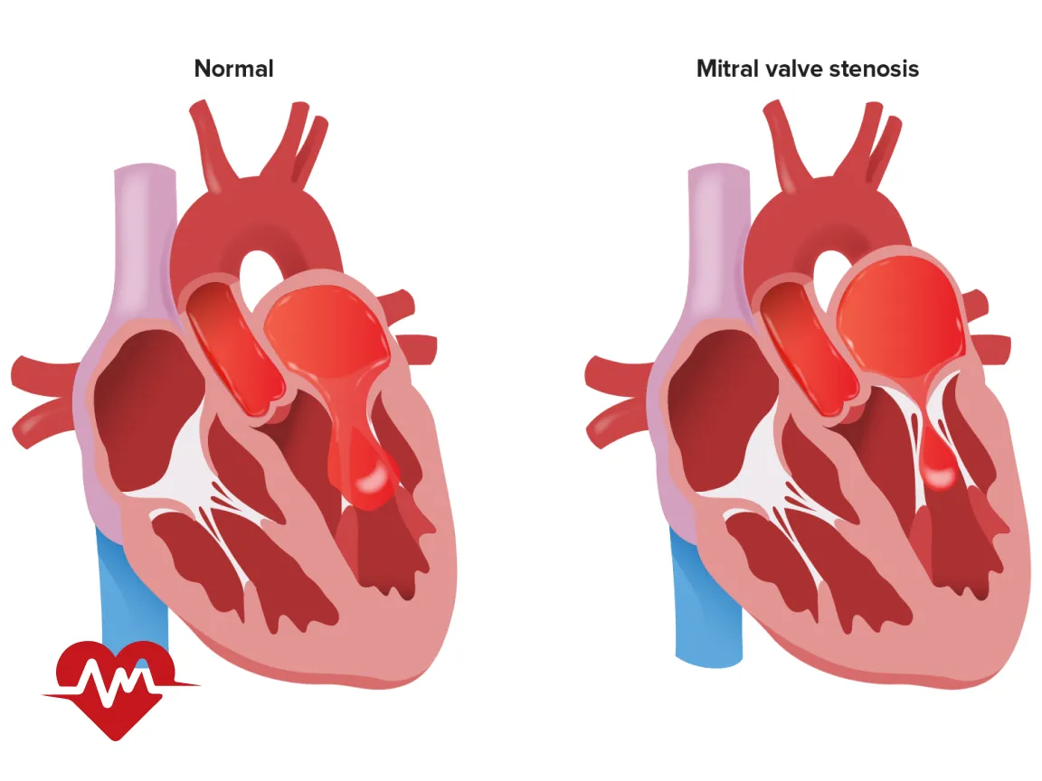 ایا تنگی دریچه میترال خطرناک است