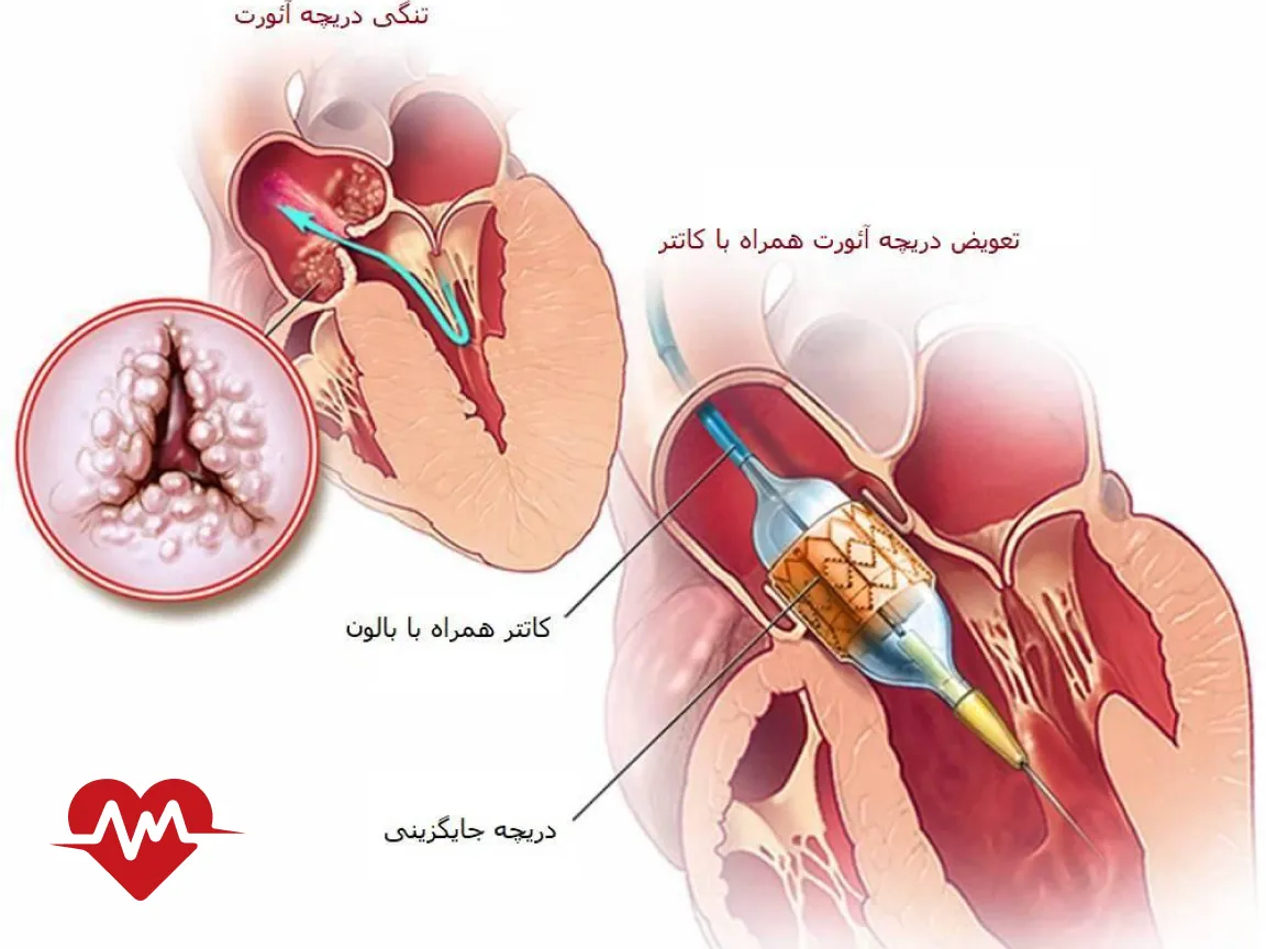 درمان تنگی دریچه آئورت بدون جراحی