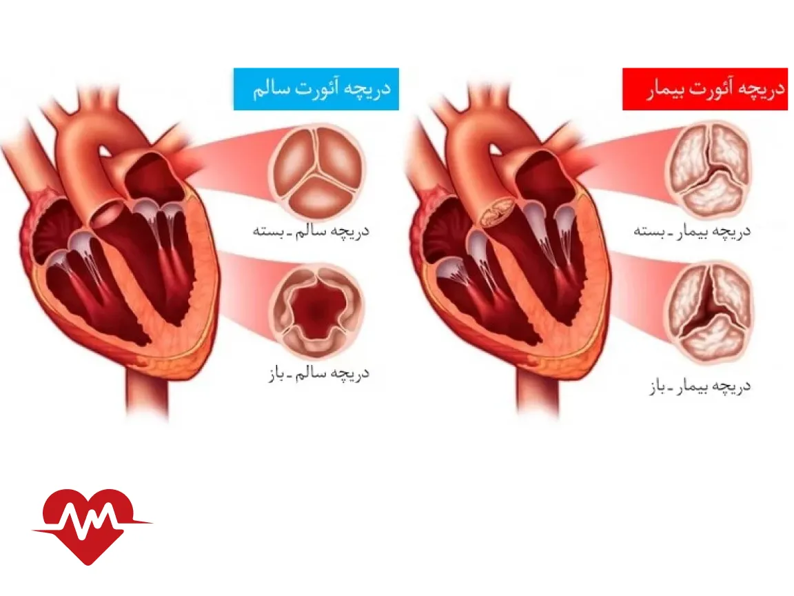 ایا نارسایی دریچه میترال درمان دارد