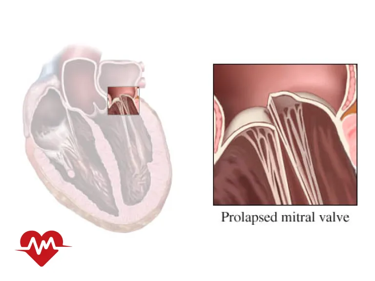 نرمی دریچه میترال قلب
