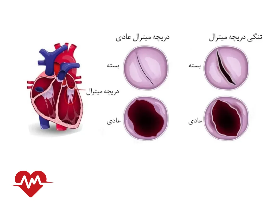 ایا تنگی دریچه میترال خطرناک است