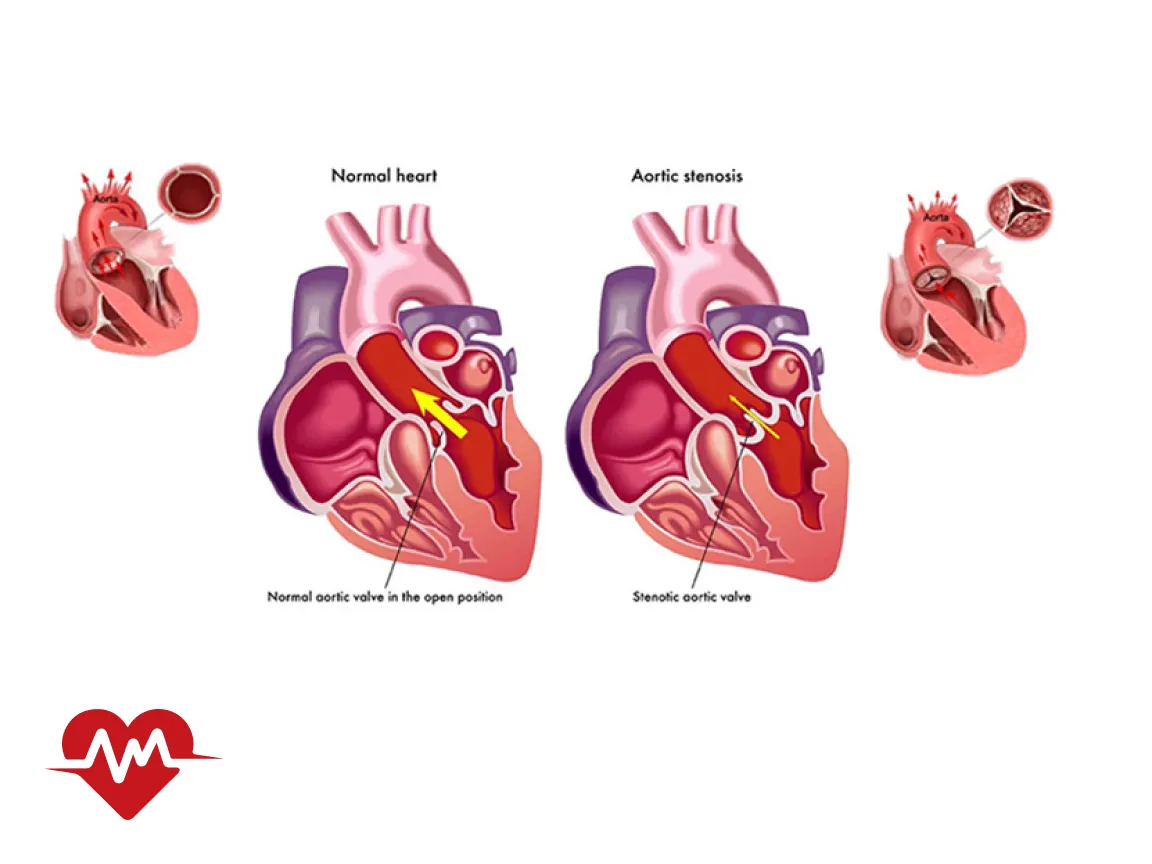 ایا تنگی دریچه ائورت خطرناک است
