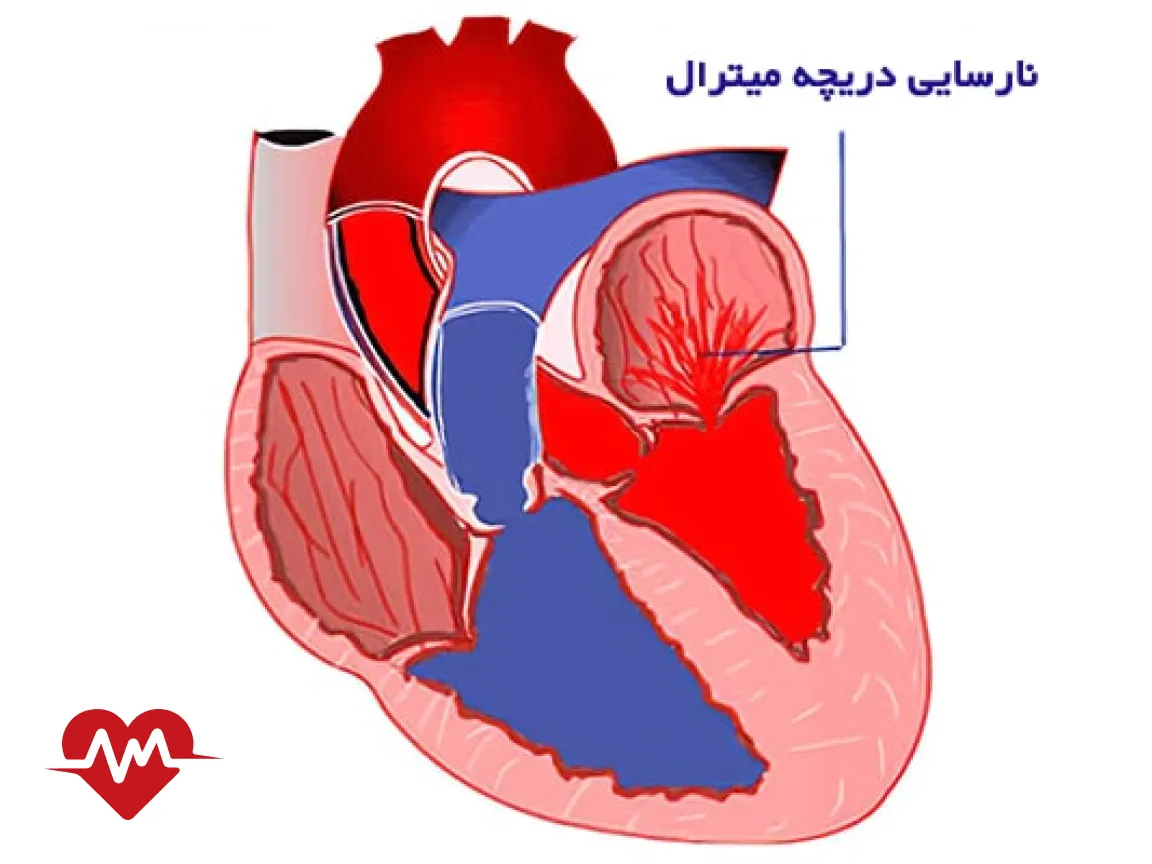 ایا نارسایی دریچه میترال درمان دارد
